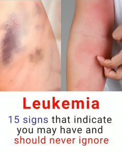 15 signs that indicate you may have leukemia, and that you should never ignore
