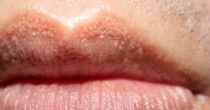 What Are Those White Bumps That Can Appear On Your Private Parts and What Causes Them?