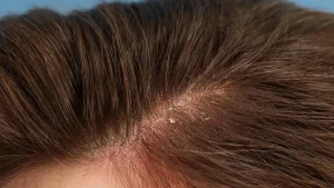 Itchy Scalp? Here Are the Most Common Causes