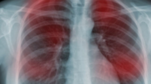 20 Early Signs Your Body is Fighting Cancer