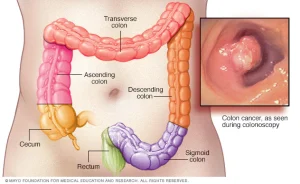 Poop and Colon Cancer: Warning Signs To Look For And When To Seek For Help