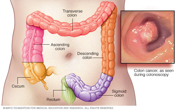 Poop and Colon Cancer: Warning Signs To Look For And When To Seek For Help
