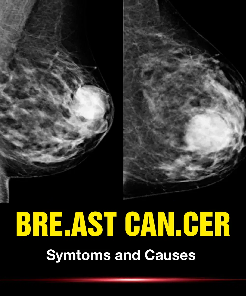 Brea.st Can.cer: Symptoms and Causes