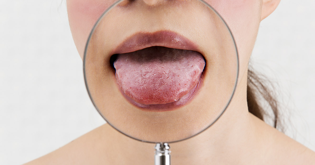 11 Things Your Tongue is Telling You About Your Health