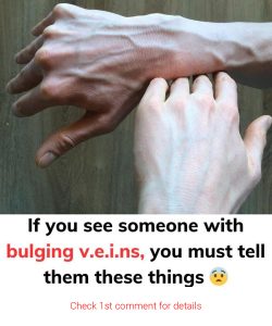 Someone with bulging v.e.i.ns