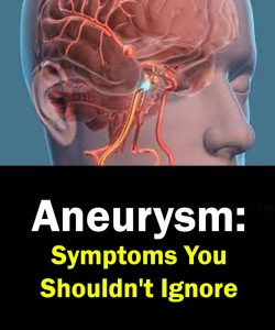 Aneurysm: Symptoms You Shouldn’t Ignore