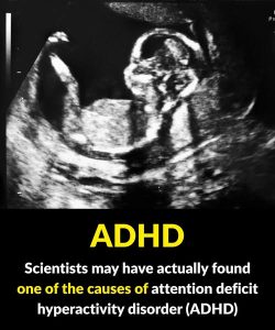 Study identifies possible connection to attention deficit hyperactivity disorder (ADHD)