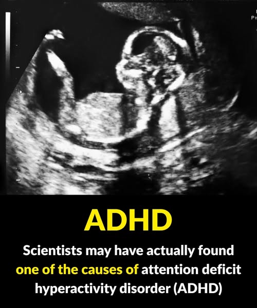 Study identifies possible connection to attention deficit hyperactivity disorder (ADHD)