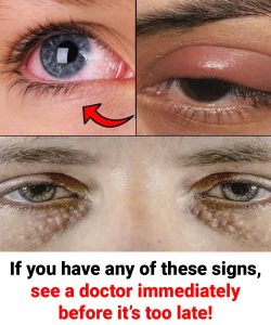 8 Things Your Eyes Say About Your Health! If you have any of these signs, you need to see a doctor right now!