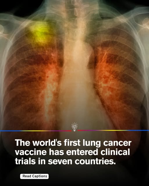 World-first lung cancer vaccine trials launched across seven countries