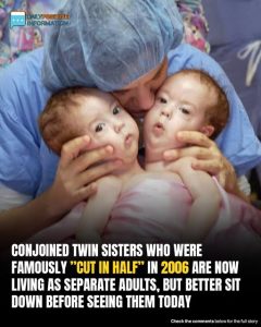 Conjoined Twins Bella And Abby Were Genuinely Associated From Birth, Yet Medical Procedure Changed Everything