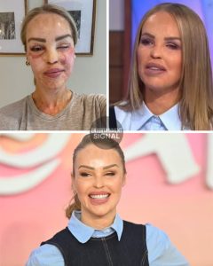 Katie Piper has undergone more than 400 surgeries following the acid attack: Katie Piper Reveals the Painful Truth About Losing ‘Pretty Privilege’ After Acid Attack – But Says She’s Now Stronger Than Ever