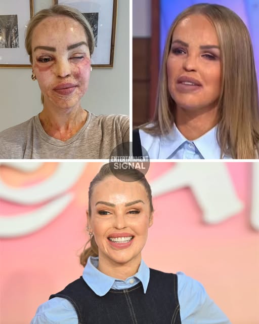Katie Piper has undergone more than 400 surgeries following the acid attack: Katie Piper Reveals the Painful Truth About Losing ‘Pretty Privilege’ After Acid Attack – But Says She’s Now Stronger Than Ever