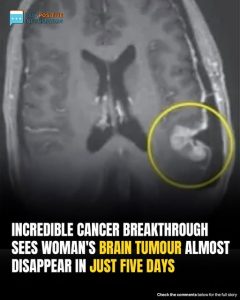 Woman’s Inoperable Brain Tumor Shrinks In Just Five Days Thanks To Cancer Breakthrough