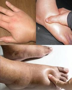 Get Rid of Swollen Hands and Feet Fast: Home Remedies for Water Retention