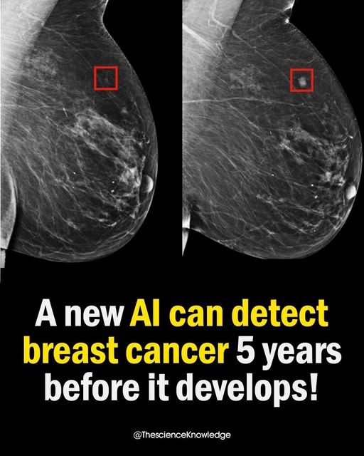 A new artificial intelligence can detect breast cancer 5 years before it develops