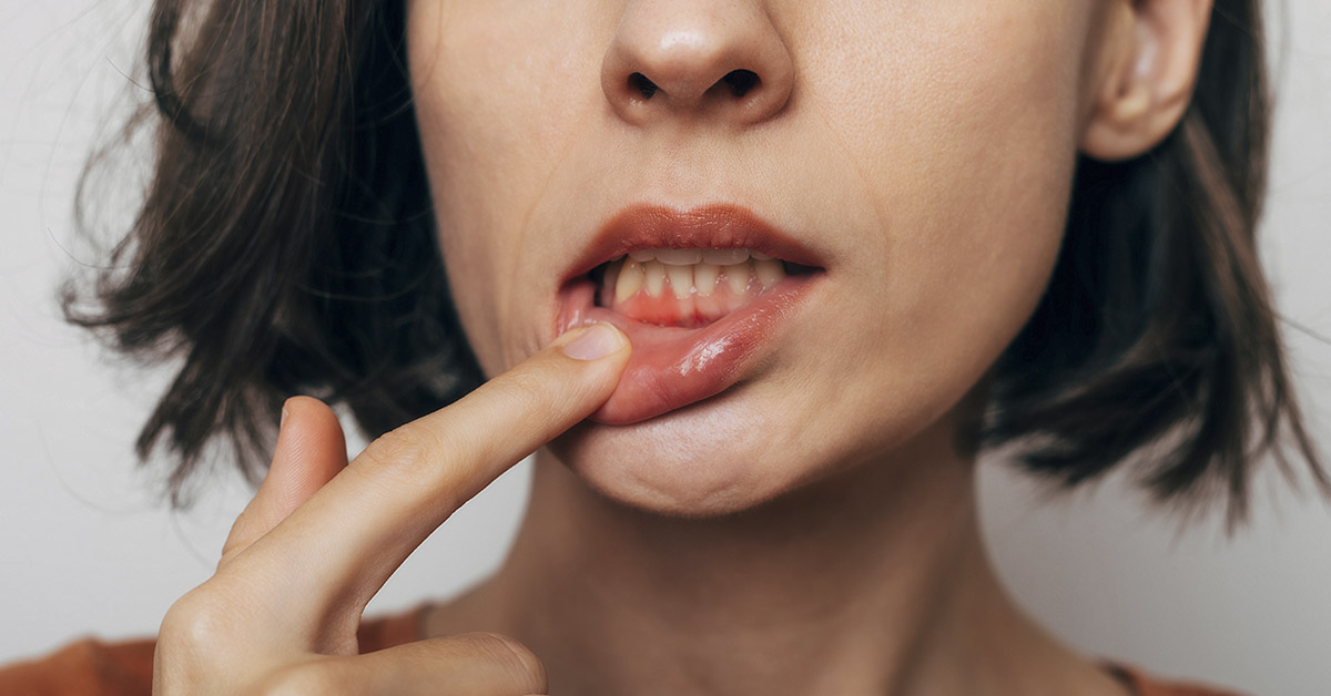 10 Simple Remedies to Help Relieve Gum Disease At Home