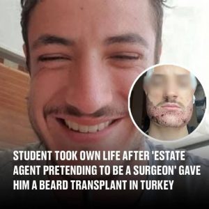 Student dies by suicide after undergoing a beard transplant in Turkey from an ‘estate agent posing as a surgeon’