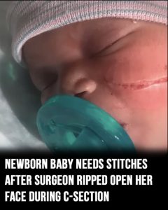 Colorado newborn’s face cut during emergency C-section, requires 13 stitches