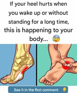 Recommended Exercises to Treat Plantar Fasciitis