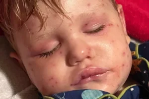 2-year-old Beckham Reed is clinging to life in a Georgia hospital after suffering over 150 yellowjacket stings, an attack that left the toddler unresponsive and requiring life support. According to family reports, Beckham was riding his electric toy car in the backyard when he unknowingly ran over a yellowjacket nest, triggering a vicious swarm that engulfed his small body within seconds.