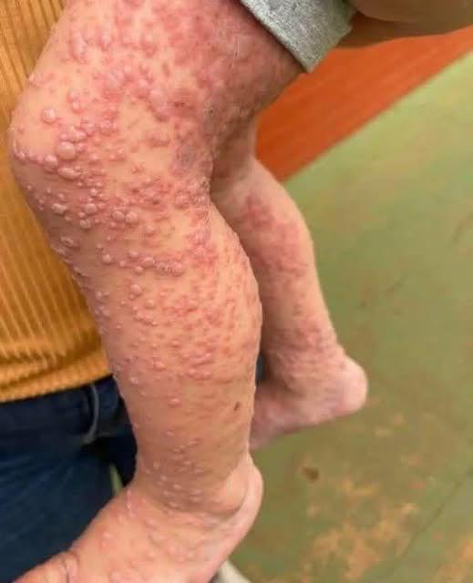His whole body was itchy, he thought it was an allergy and was diagnosed…See more…