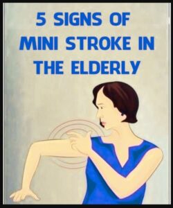 Understanding Mini Strokes in the Elderly