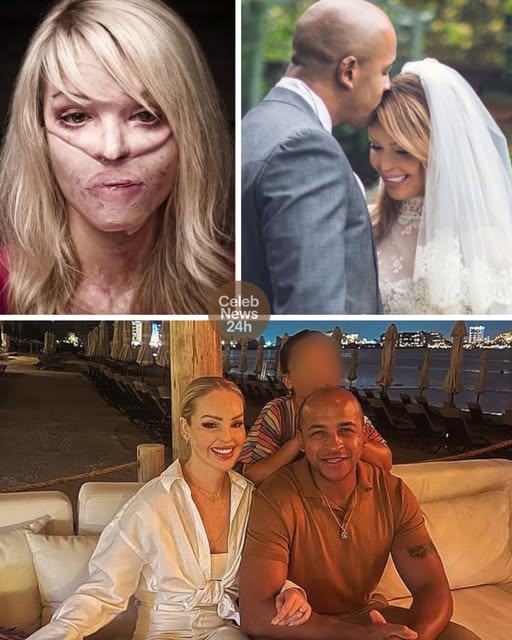 Scarred for life after an acid attack but still loved by her husband – Katie Piper says marriage is “hard but worth it” after 10 years