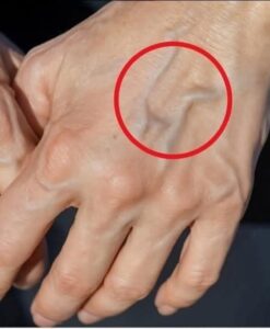 Natural Remedies to Improve the Health of Your Veins and Skin