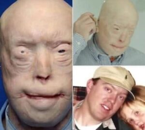 Firefighter suffers third-degree burns, this is him 7 years later
