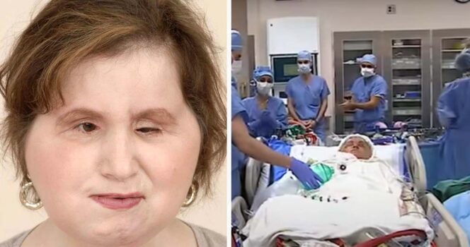 The amazing story of Katie Stubblefield: She became the youngest person to receive a face transplant