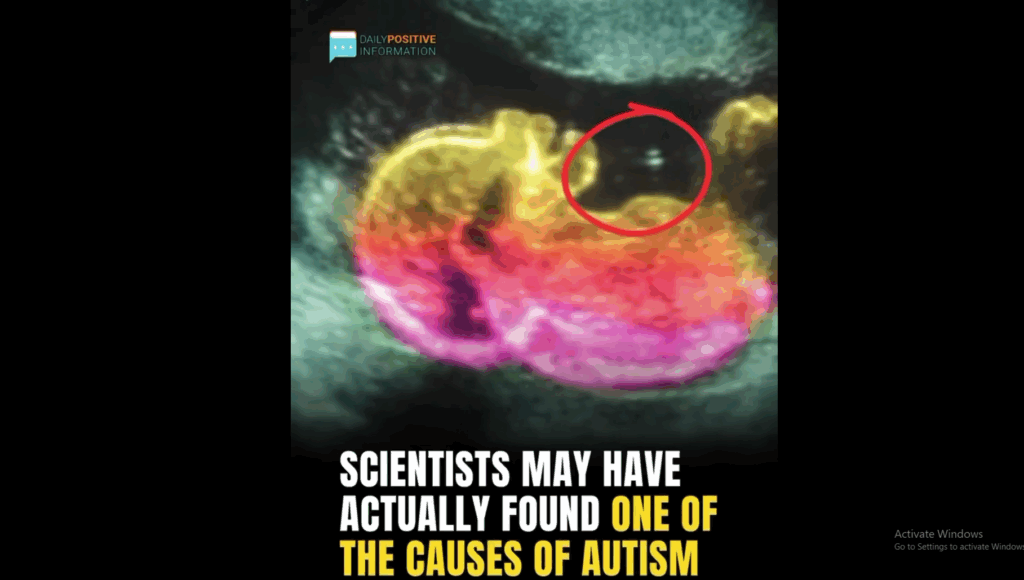 Study identifies possible connection to autism development