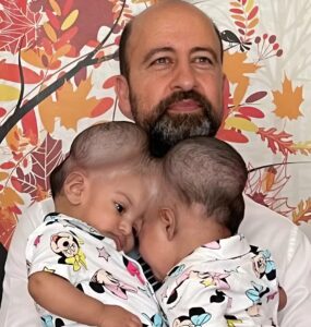 These sisters were born with fused heads 😨. They shared a cranial bone, and the separation surgery could have ended very badly 😢. When the girls turned 3, doctors decided to perform the operation. The surgery lasted 14 hours and was successful 😍. Today, the parents can hug each daughter separately 💖. Curious how the sisters look now? Their photos after the separation were shown in the first comment ⬇️⬇️