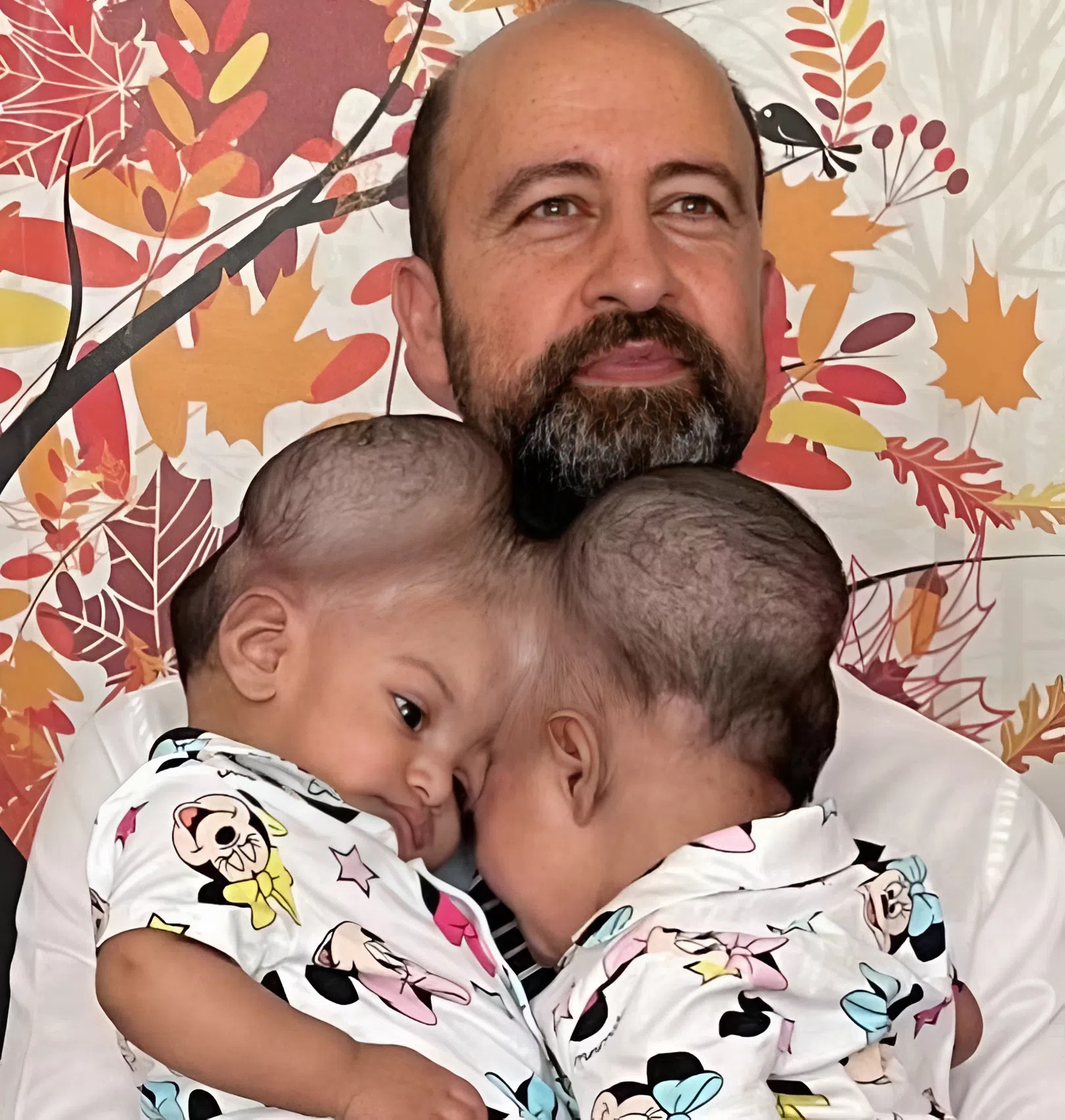 These sisters were born with fused heads 😨. They shared a cranial bone, and the separation surgery could have ended very badly 😢. When the girls turned 3, doctors decided to perform the operation. The surgery lasted 14 hours and was successful 😍. Today, the parents can hug each daughter separately 💖. Curious how the sisters look now? Their photos after the separation were shown in the first comment ⬇️⬇️