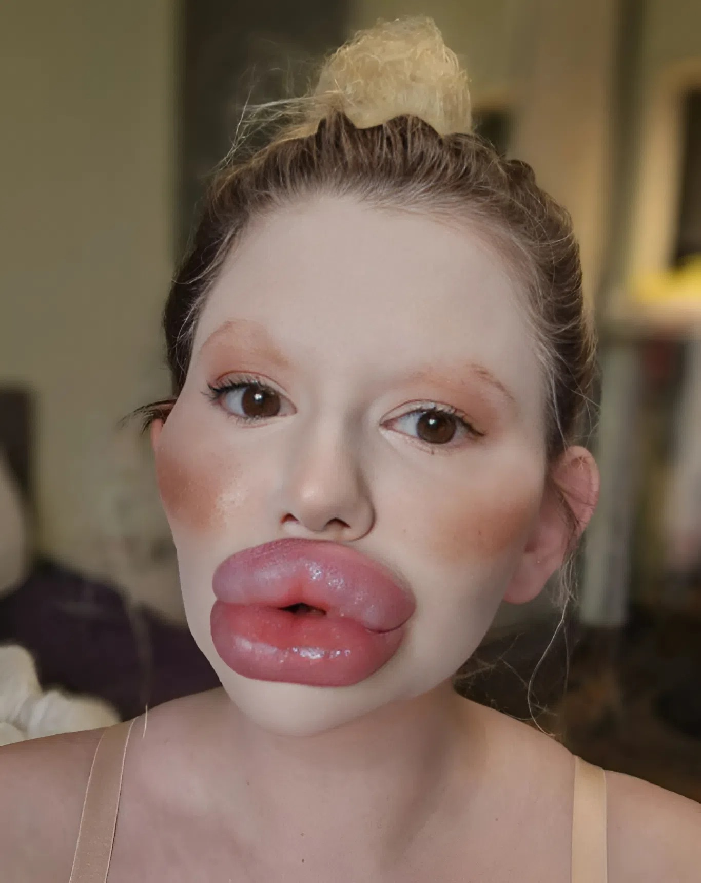 This girl spent $26,000 just on lip enhancement and became the woman with the biggest lips
