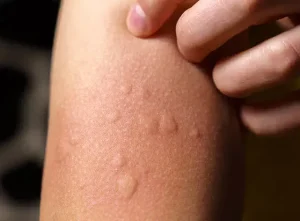 Why do hives appear on the skin? These are the surprising factors you might not know about.