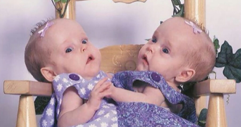 Cojoined twin sisters who were famously ‘cut In half’ in 2006 are now living as separate teenagers