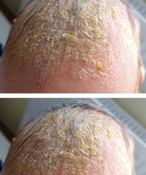 Oozing yellow crust on my scalp won’t cure. Clinic waitlist is long. What is it?