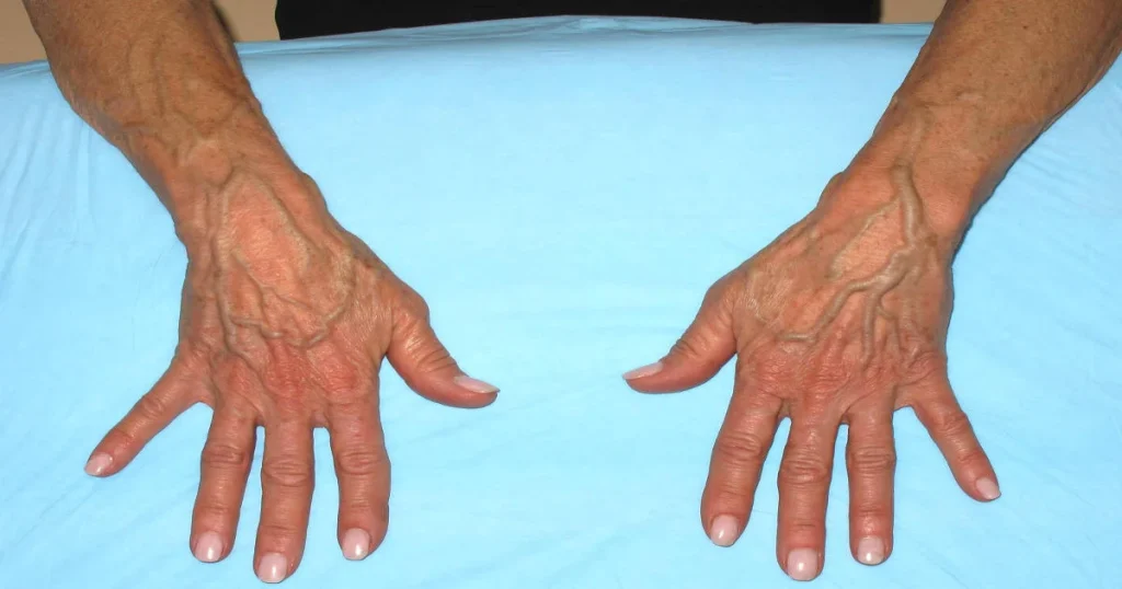When to Worry About Veins That Appear Out of Nowhere