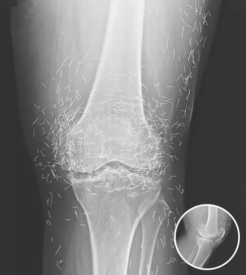 Doctors Stunned After Looking At This X-Ray Of Woman Suffering Joint Pain