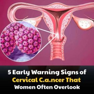 5 early warning signs of cervical cancer