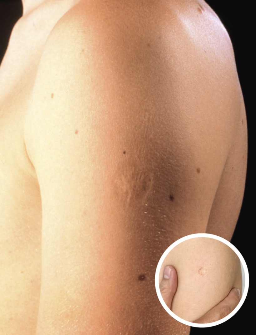 Here's The Truth Behind This Scar On People's Upper Left Arm