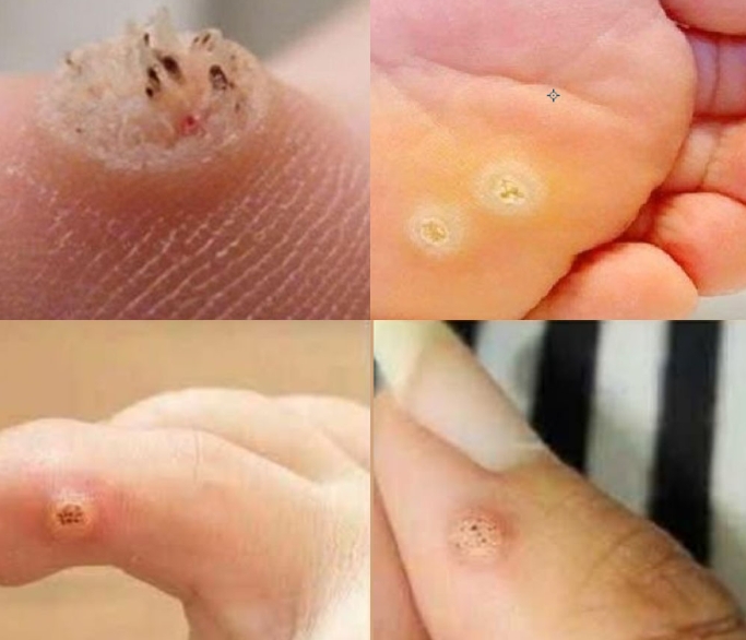 Be Very Careful: If You Notice This Skin Growth, It Could Be Serious