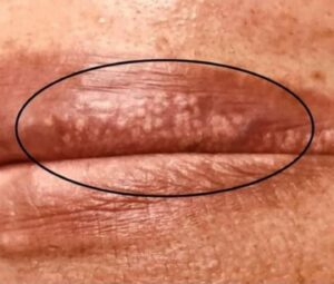 When You Should See a Dermatologist for White Pimples