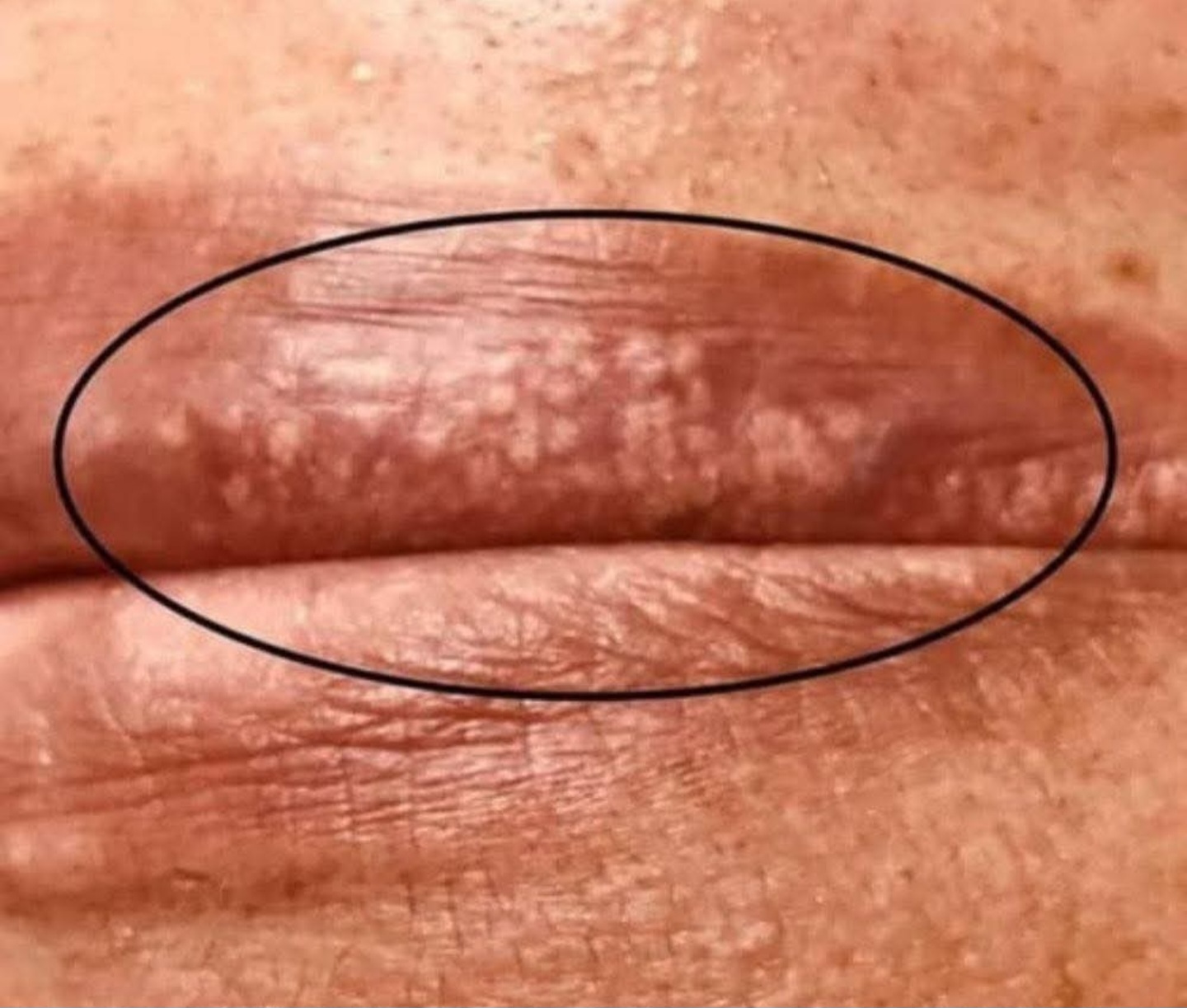 When You Should See a Dermatologist for White Pimples