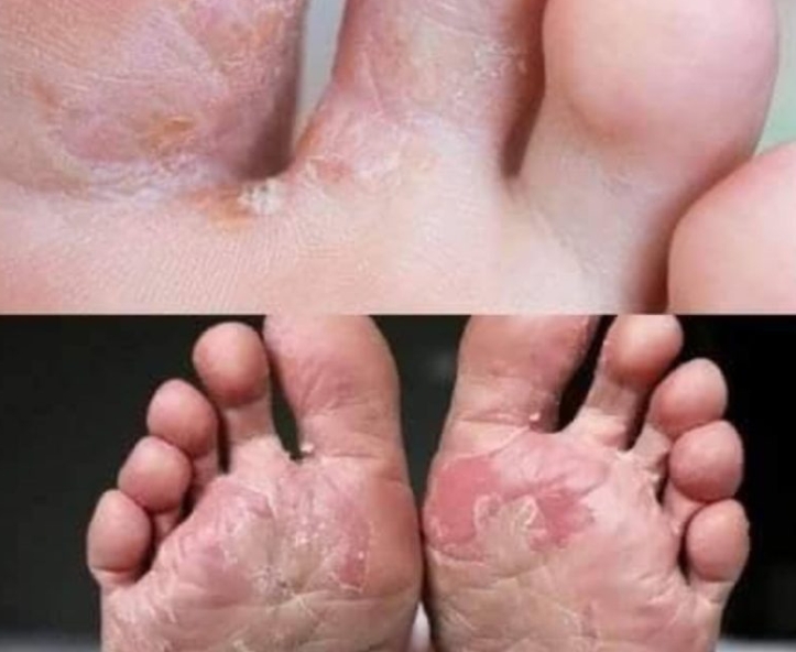 War:ning: If you have this on your feet, it may be a sign of hidden diabetes,