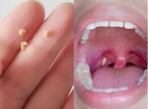 Bad breath: a home remedy to get fresh breath