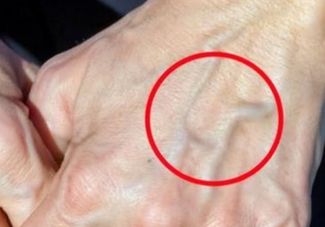 When to Worry About Veins That Appear Out of Nowhere
