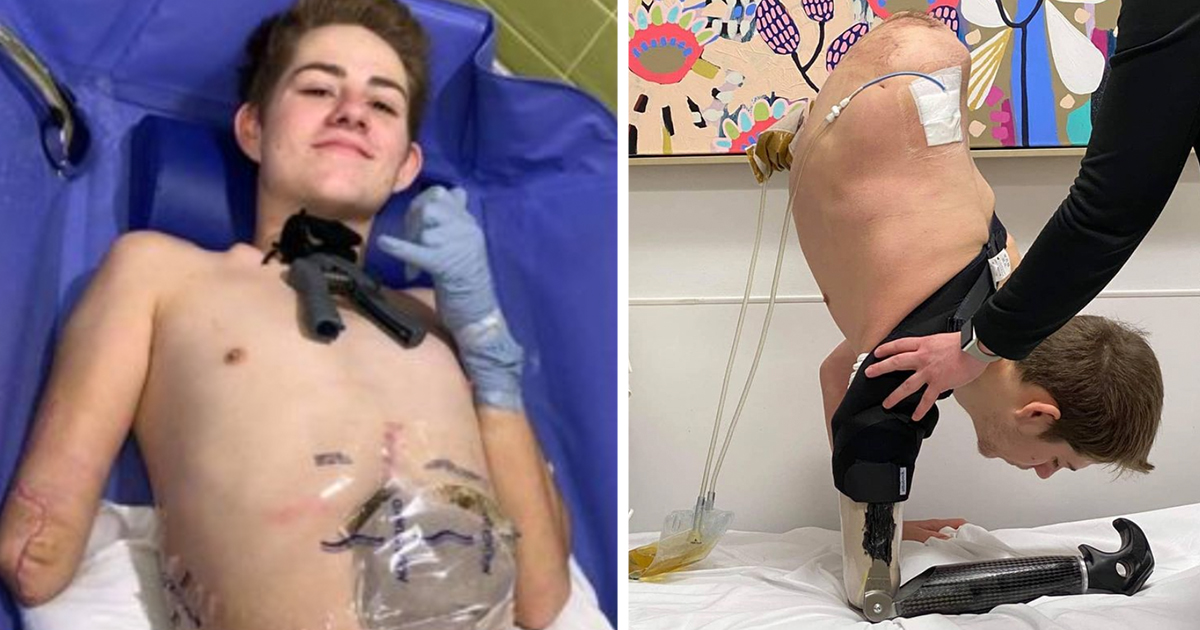 19-year-old crushed by forklift chooses to amputate bottom half of his body
