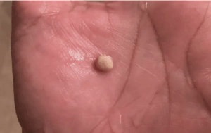 Here’s What You Need to Know About Tonsil Stones